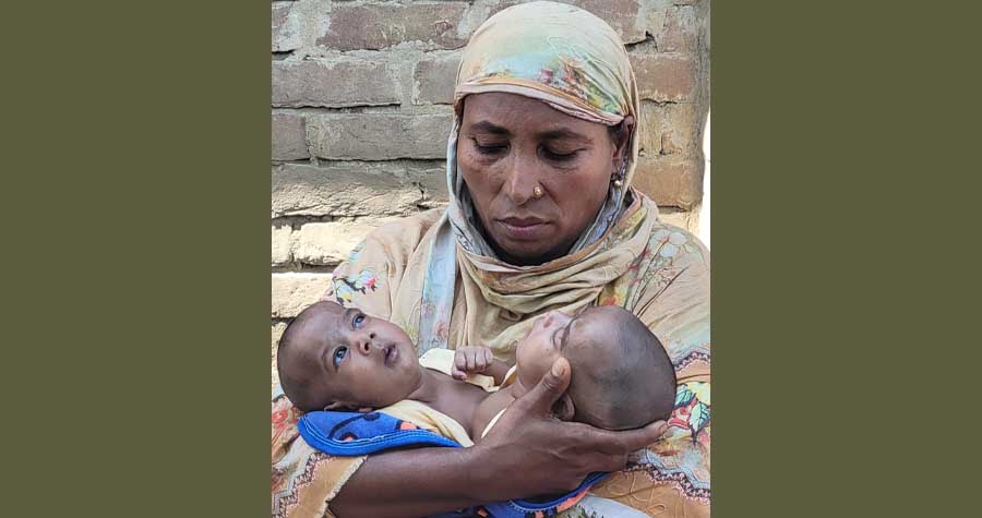 দৌলতপুরে সংযুক্ত জমজ কন্যার জন্ম, বাঁচানোর আকুতি দিনমজুর বাবার
